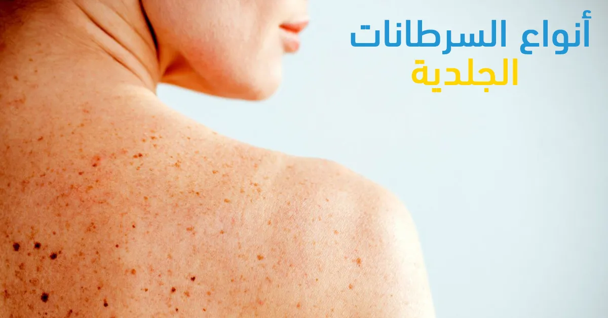 أنواع السرطانات الجلدية